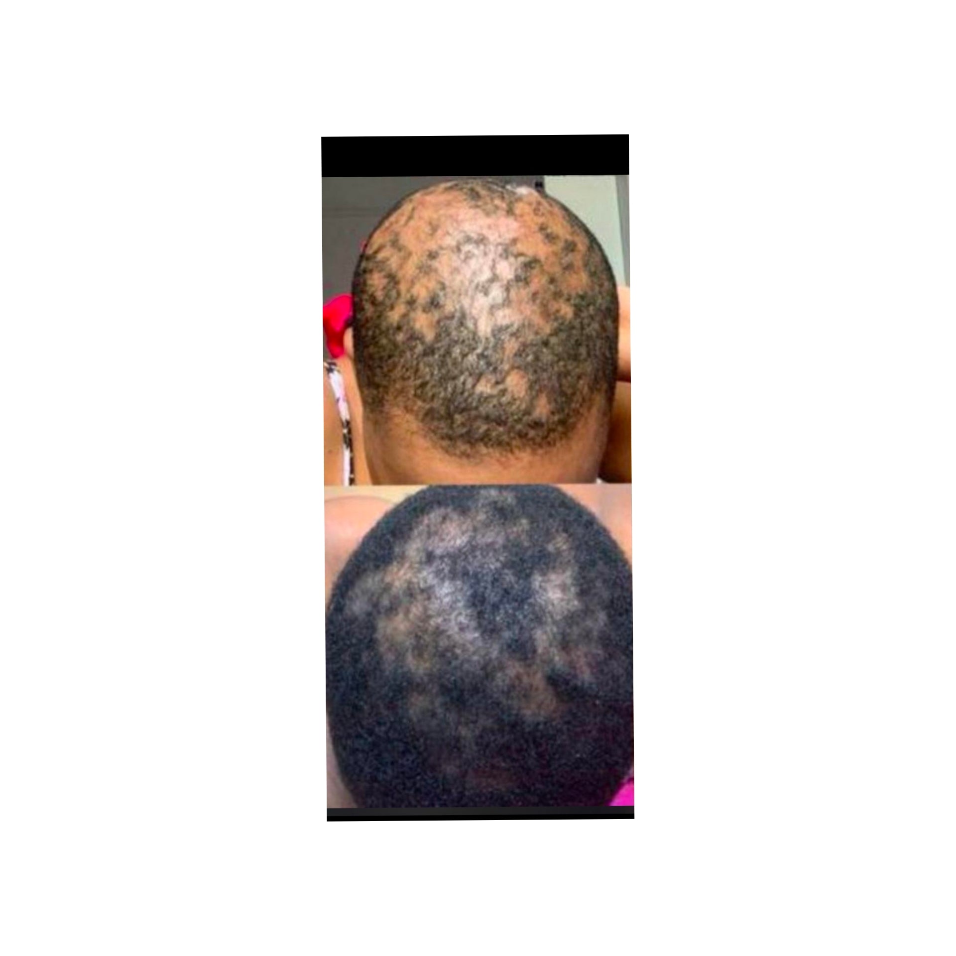 Minoxi Miracle Follicle Activating Serum ( High quality 10% Minoxidil Effective Treatment for hair loss)