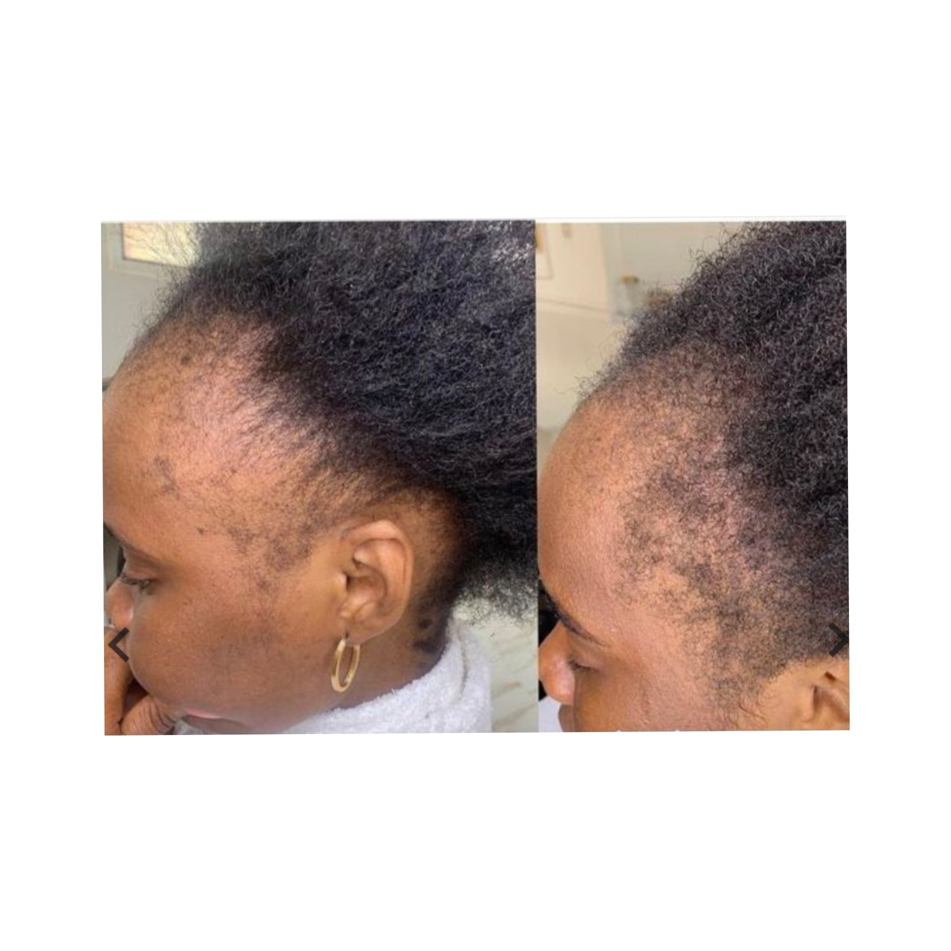 Minoxi Miracle Follicle Activating Serum ( High quality 10% Minoxidil Effective Treatment for hair loss)