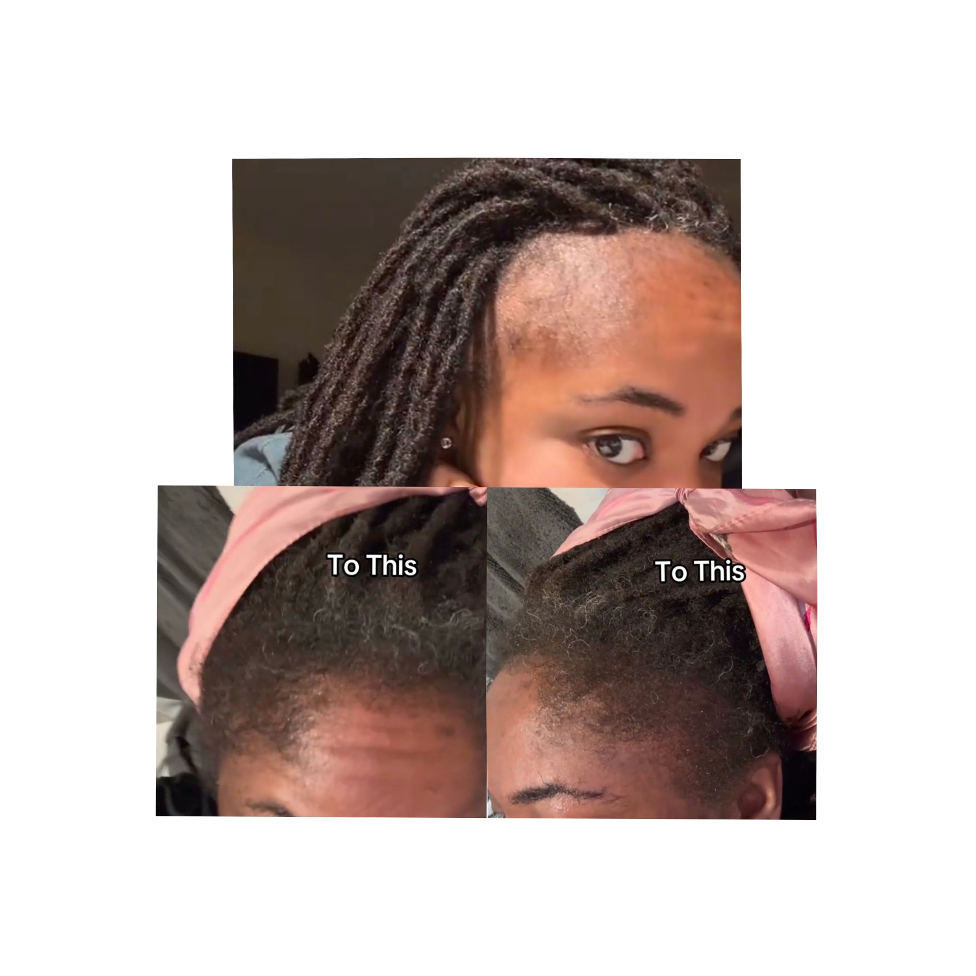 Minoxi Miracle Follicle Activating Serum ( High quality 10% Minoxidil Effective Treatment for hair loss)